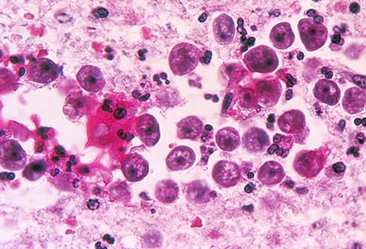 Brain-Eating Amoeba Brain-Eating Amoeba