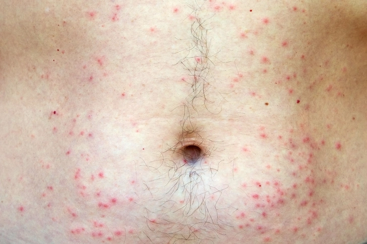 Folliculitis Folliculitis