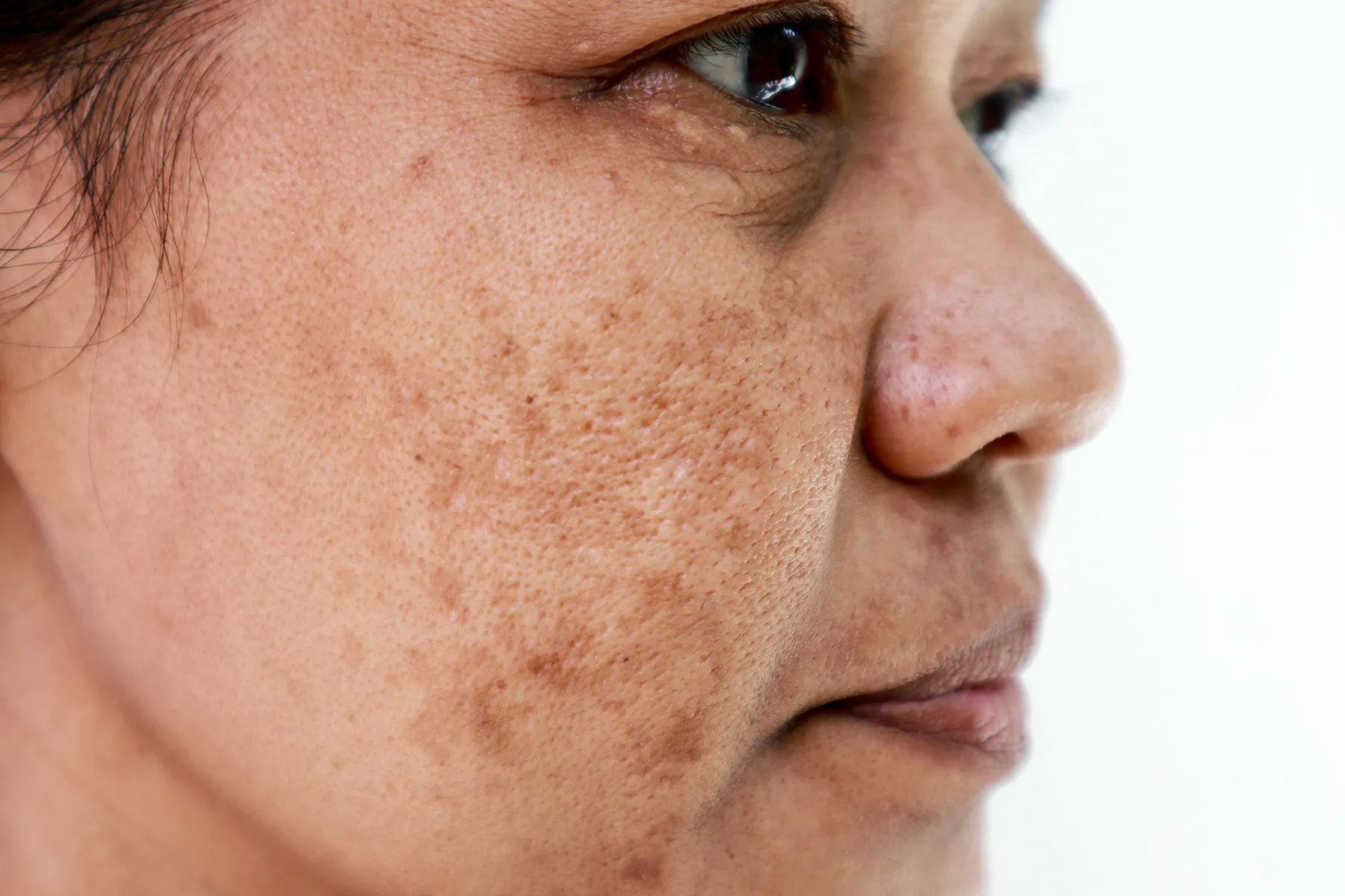 photo of melasma