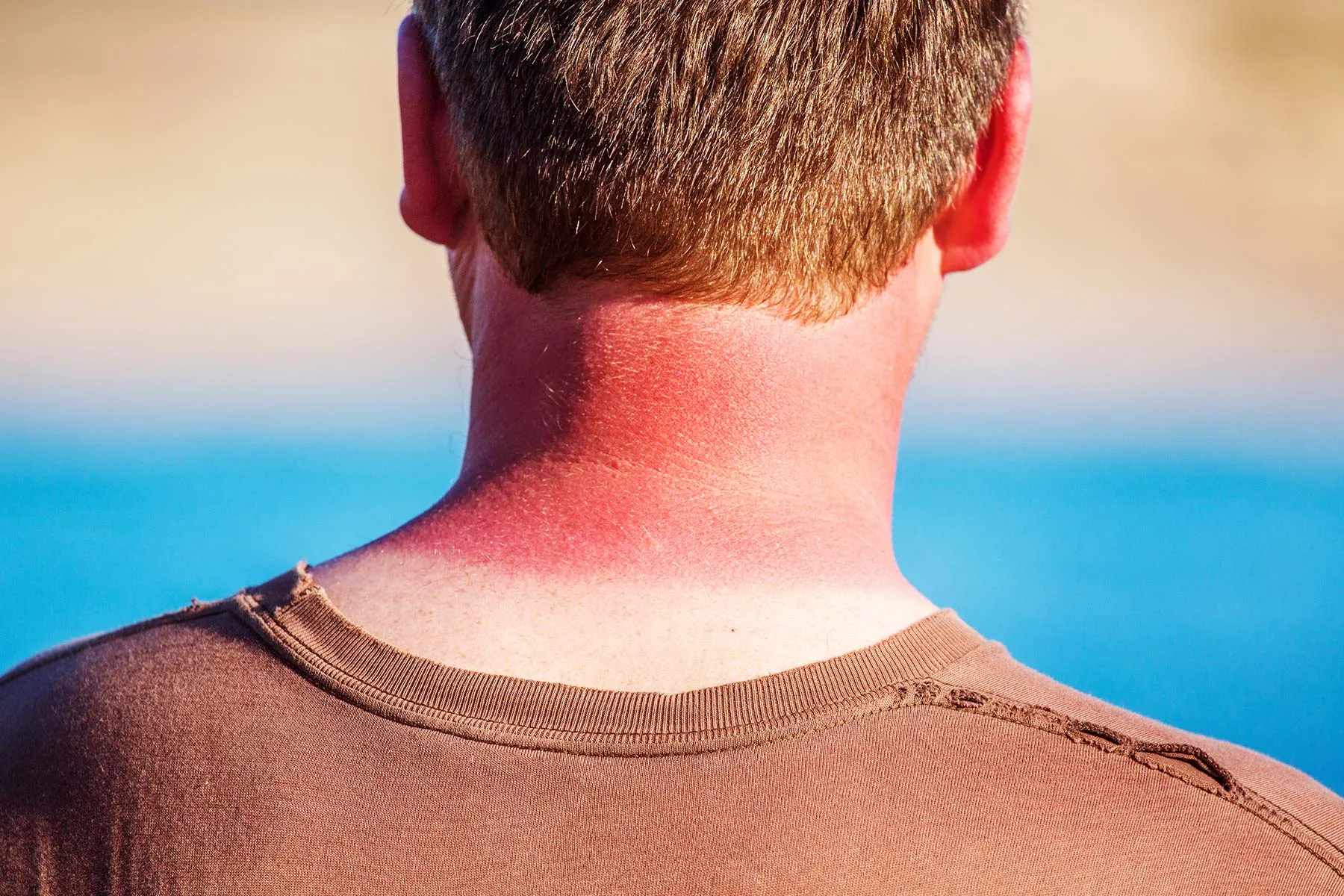 photo of sunburn