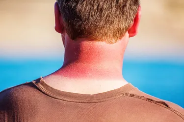 A sunburn is skin damage from the sun's ultraviolet (UV) rays. Most are mild and can be treated at home. But sunburn also increases your risk of melanoma and other skin cancers. Photo credit:John White Photos / Getty Images