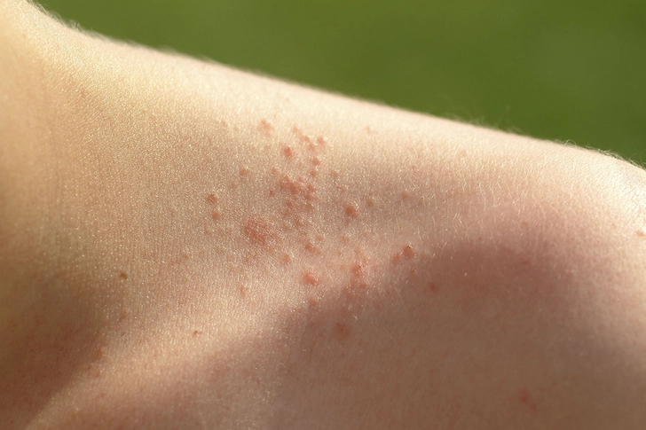 Heat Rash Heat Rash