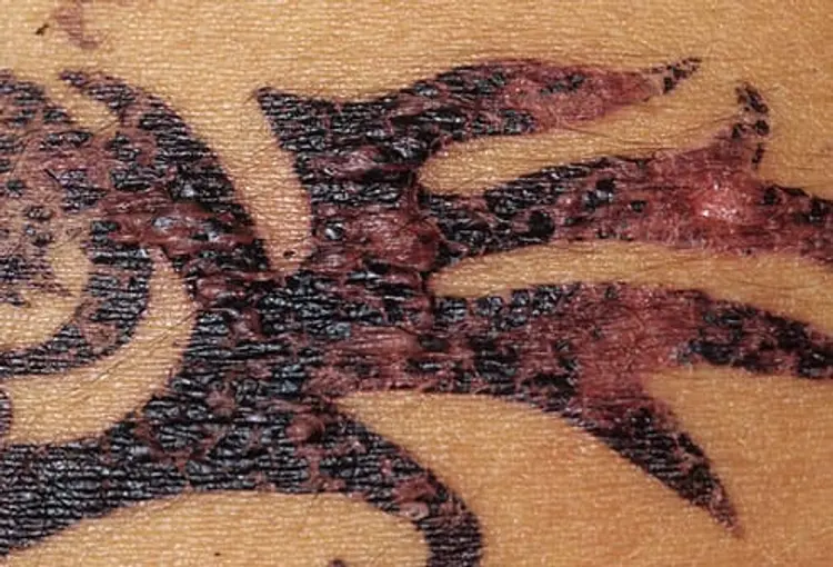 Allergic reaction to henna tattoo