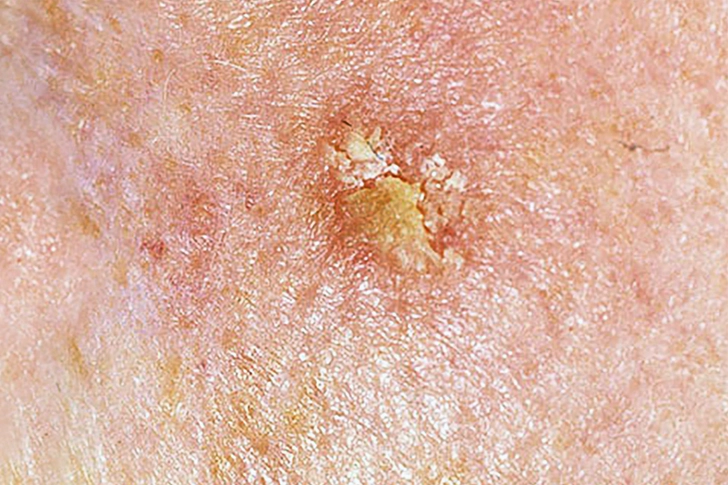 Actinic Keratosis (Solar Keratosis)