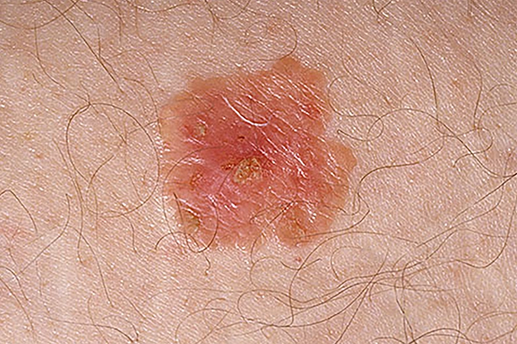 Bowen Disease