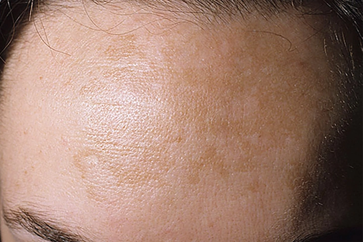 Melasma (Pregnancy Mask)