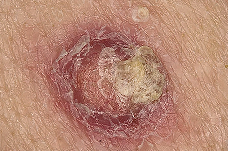 Squamous Cell Carcinoma