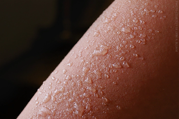 Sunburn (Second Degree)