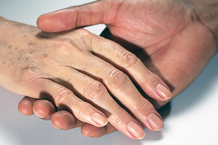 Age Spots (Solar Lentigines)