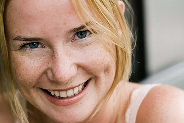 Freckles