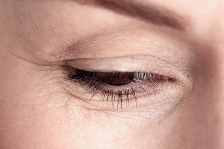Wrinkles