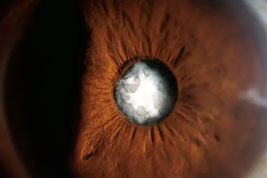 photo of cataract on eye lens