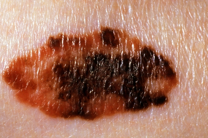 Melanoma