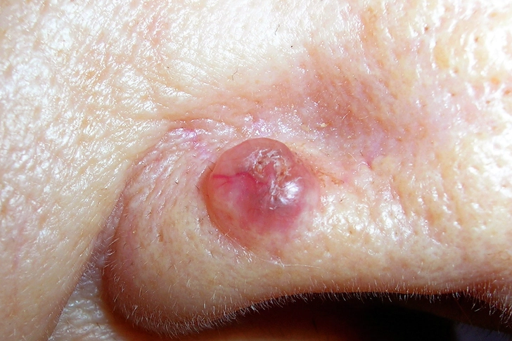 Basal Cell Carcinoma