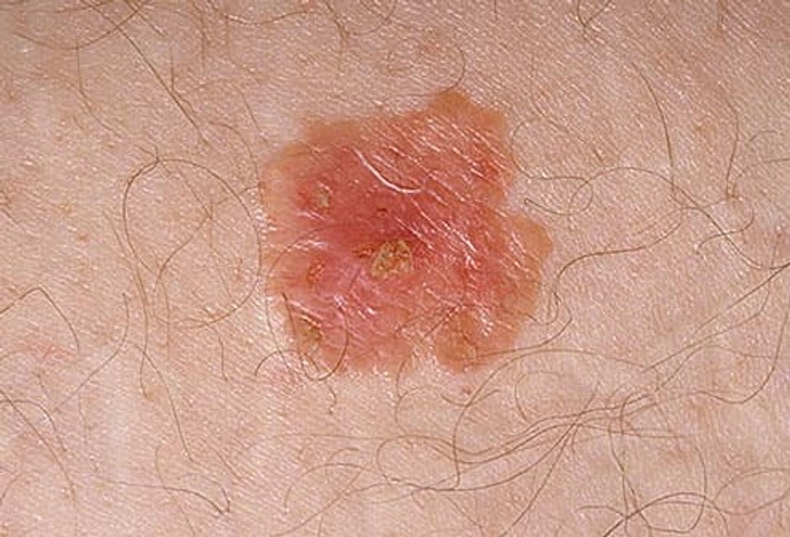 Bowen Disease