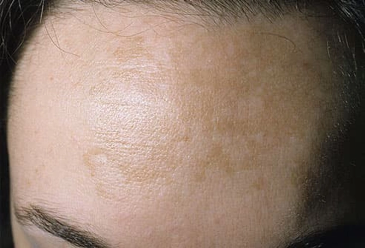 Melasma ('Pregnancy Mask') Melasma ('Pregnancy Mask')