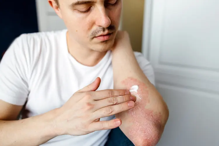 photo of rubbing cream on eczema patch near elbow