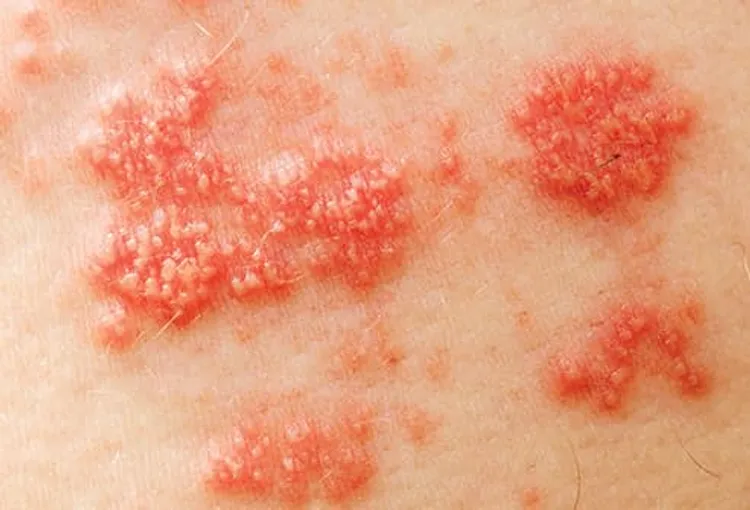 shingles skin rash
