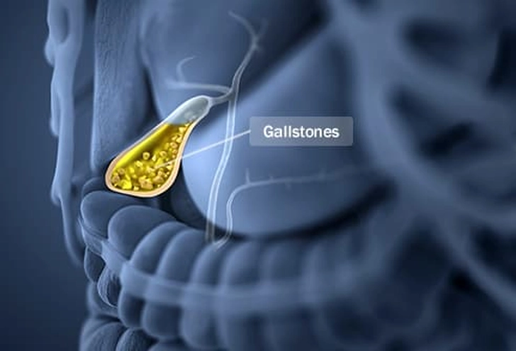 Gallstones