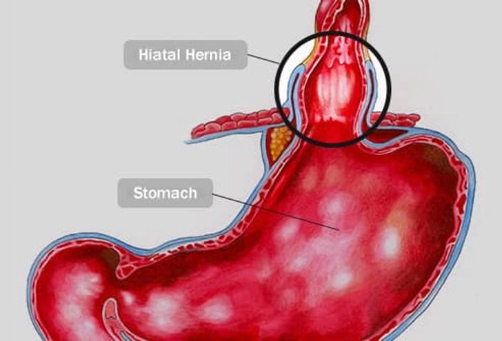 Hernia Hernia
