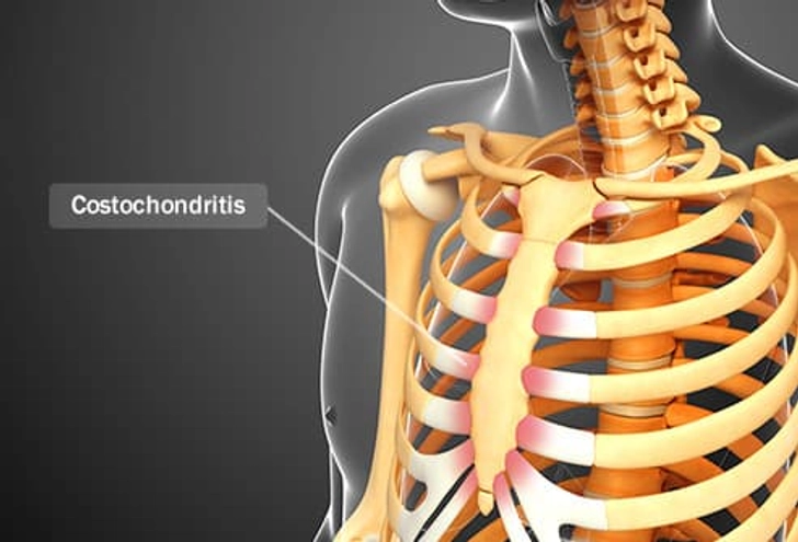 Costochondritis Costochondritis