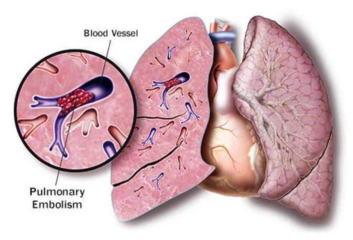 Pulmonary Embolism Pulmonary Embolism