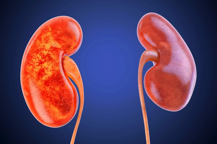 Kidney Problems