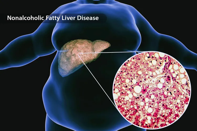 photo of nonalcoholic fatty liver disease