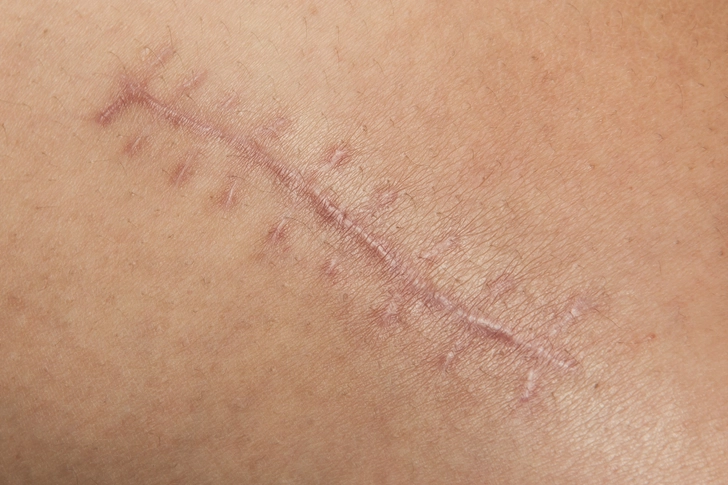 Scarred Nerves Scarred Nerves