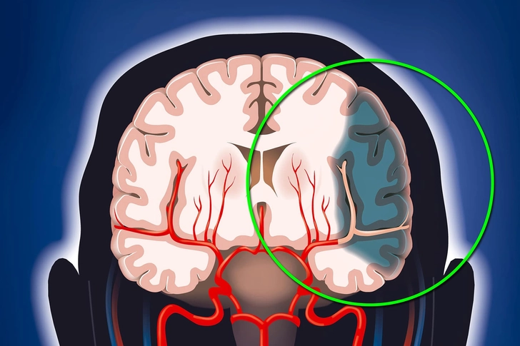 Stroke
