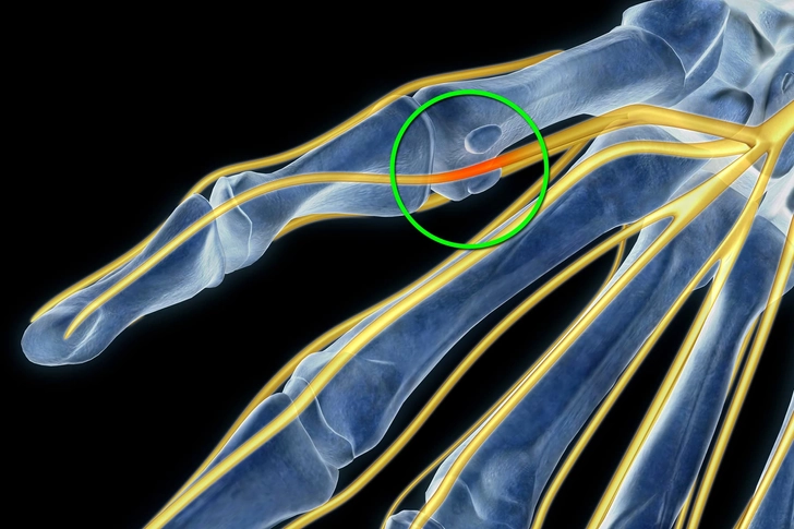 Pinched Nerve