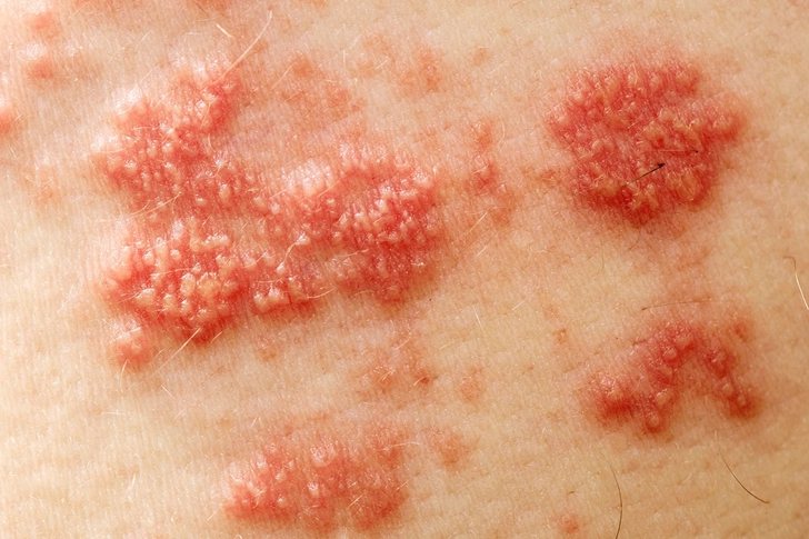 Shingles