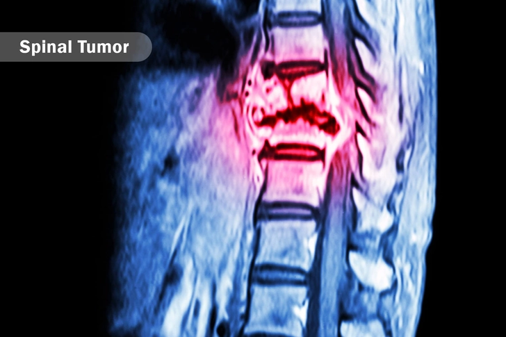 Tumors