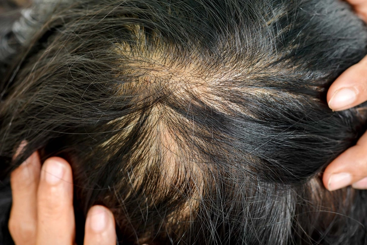 Hair Loss