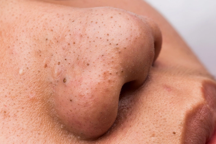 Unclog Your Pores
