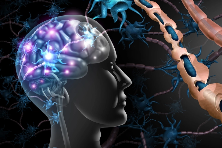 Multiple Sclerosis Multiple Sclerosis