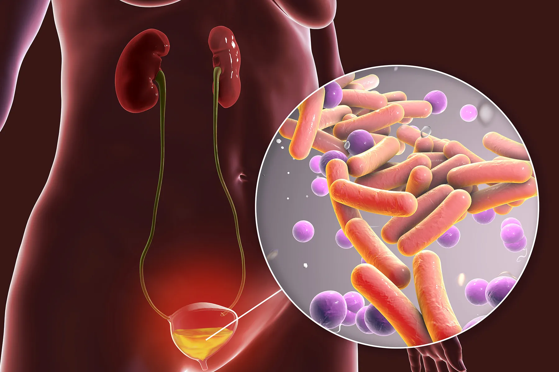 Bladder Inflammation (Cystitis): Causes, Symptoms, and Treatment