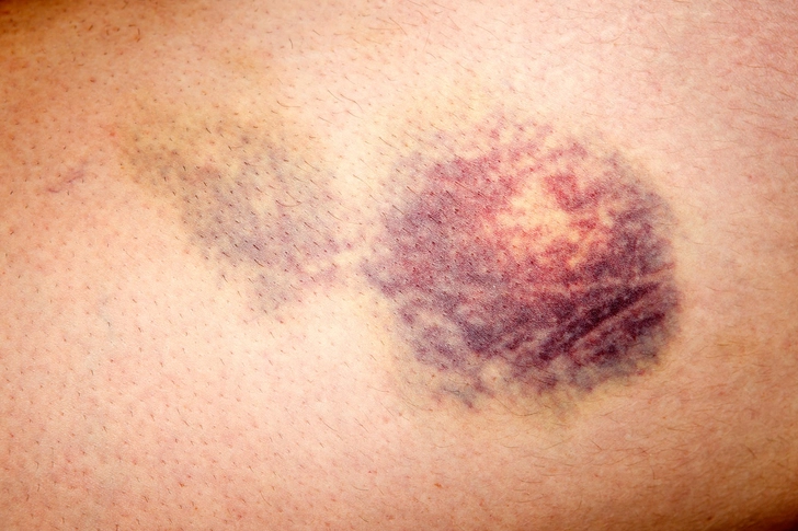 Bruising Easily or Bleeding