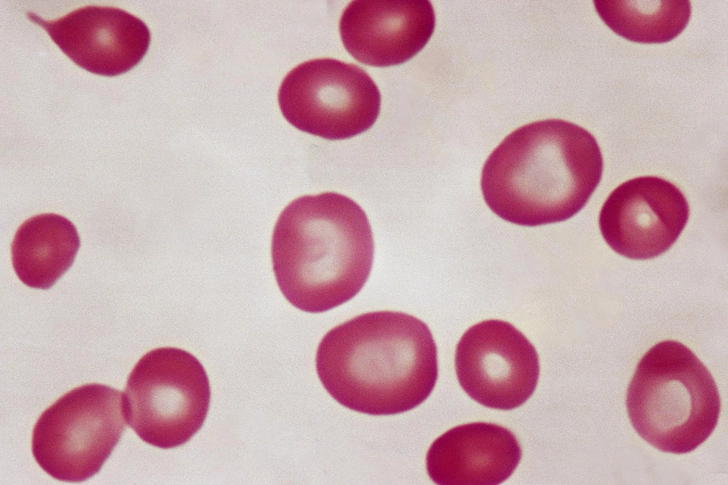 Anemia