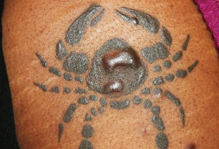 Keloids