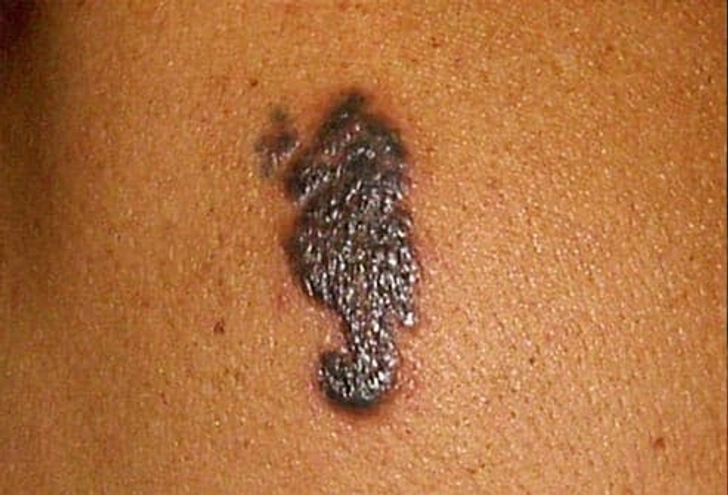 Granulomas