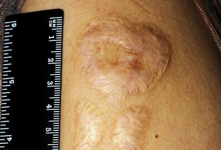 Problems With Removal Problems With Removal