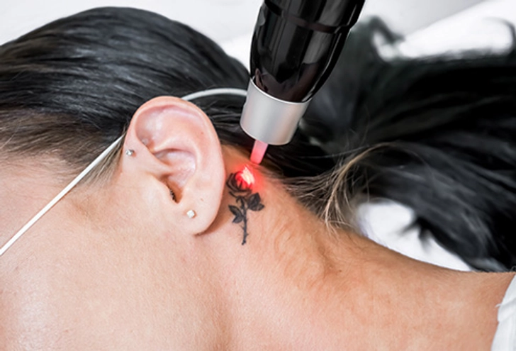 Tattoo Removal Techniques