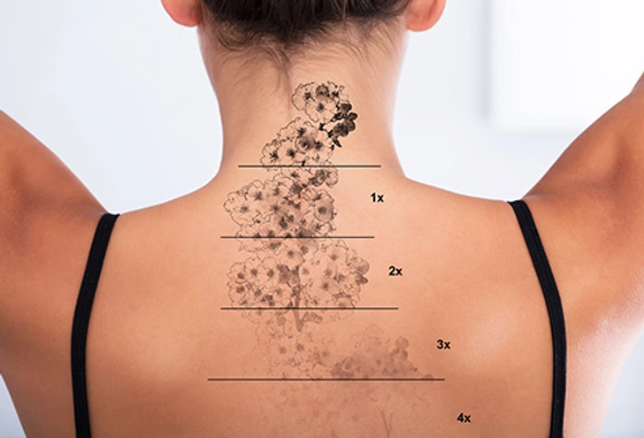 Tattoo Removal