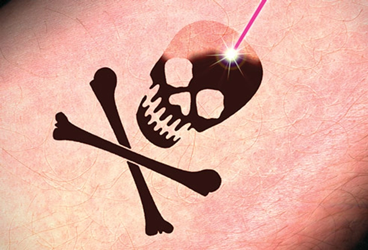 Tattoo Removal: What to Expect