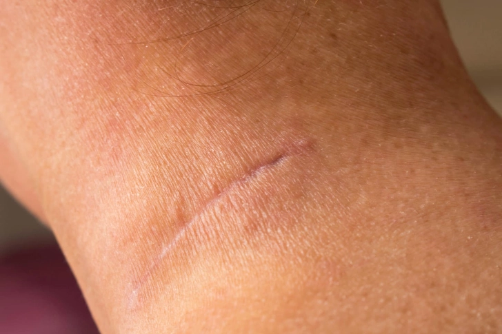 Diminishes Scars