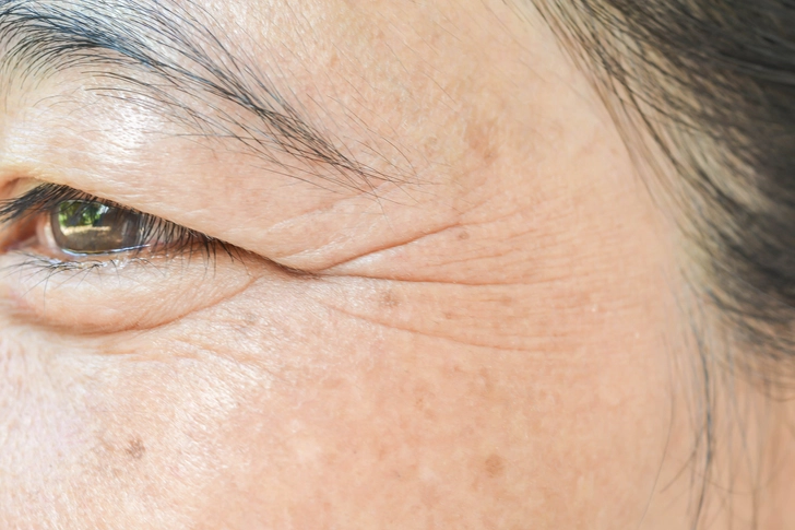 Retinoids for Wrinkles