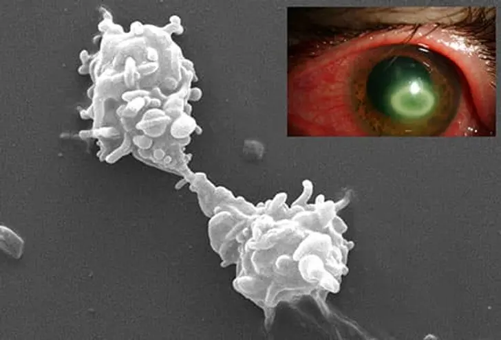 Acanthamoeba