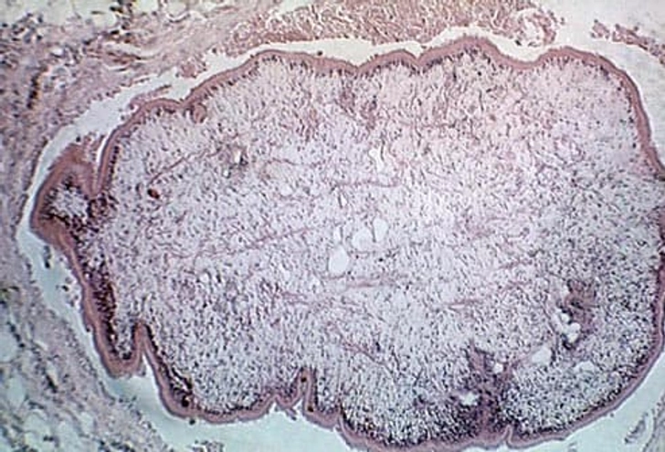 Sparganum