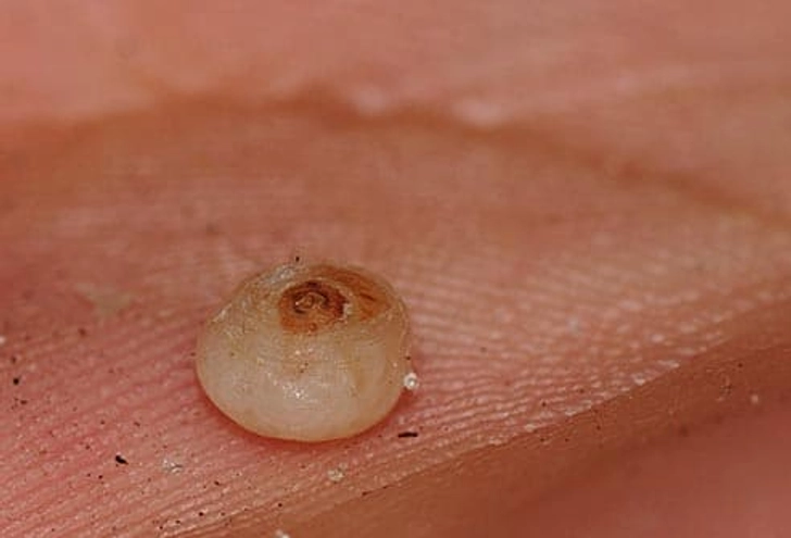 Chigoe Fleas